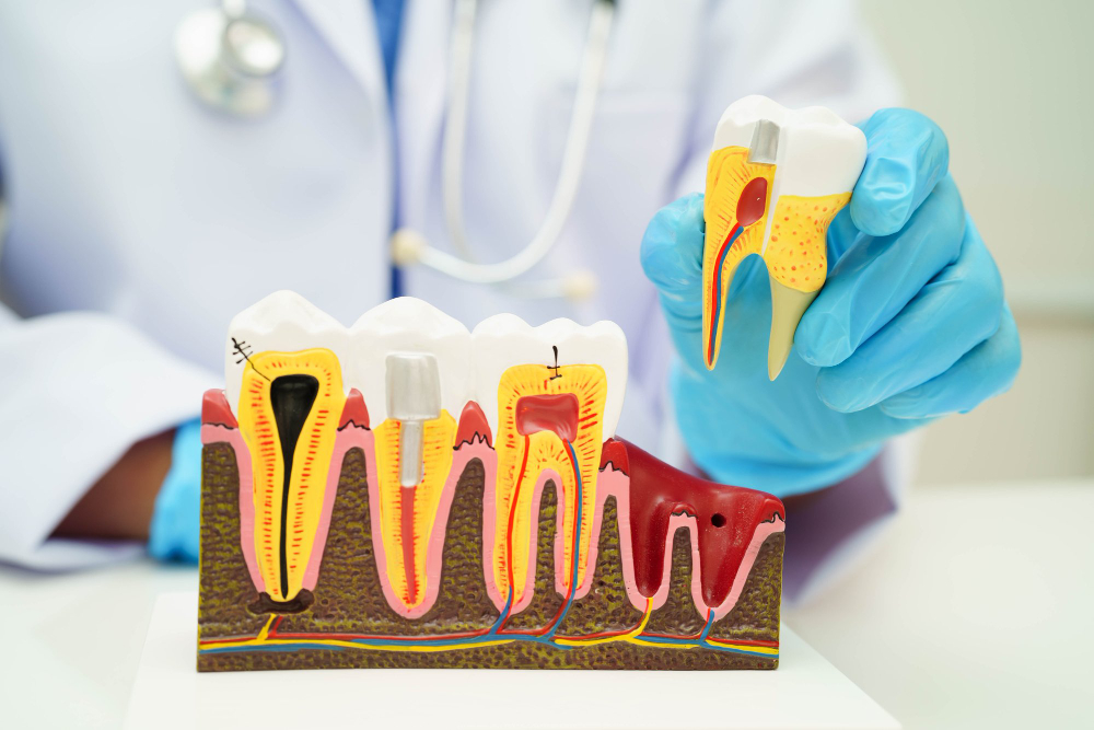 Root Canal Treatment