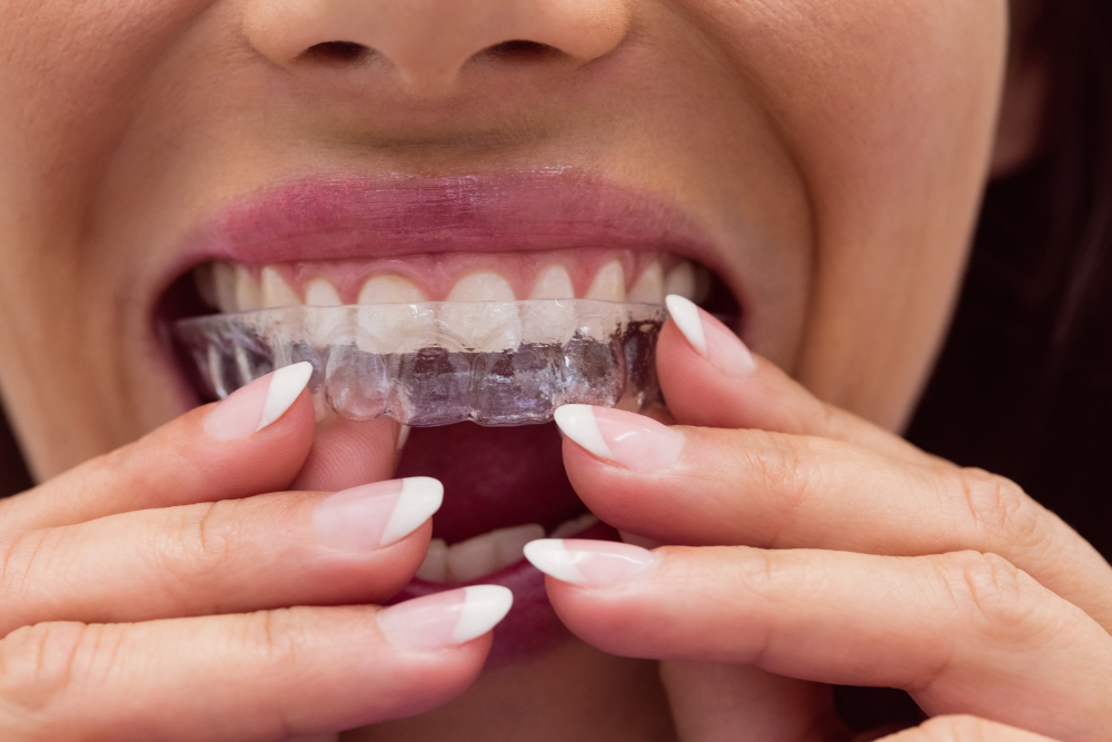 Braces
